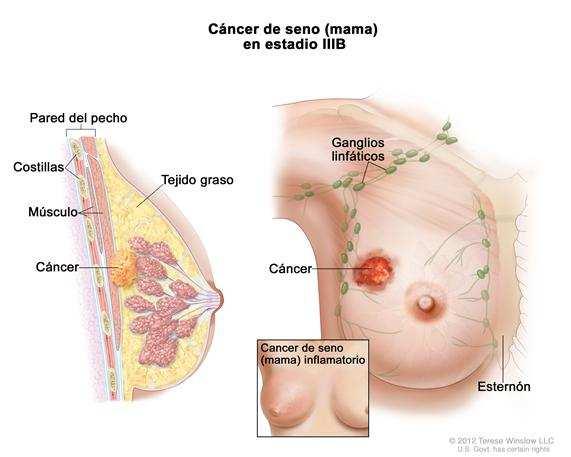 Mastectomia Indicação: carcinoma da mama.