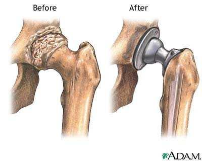 Artroplastia Cirurgia plástica de uma articulação para restabelecimento da sua função.