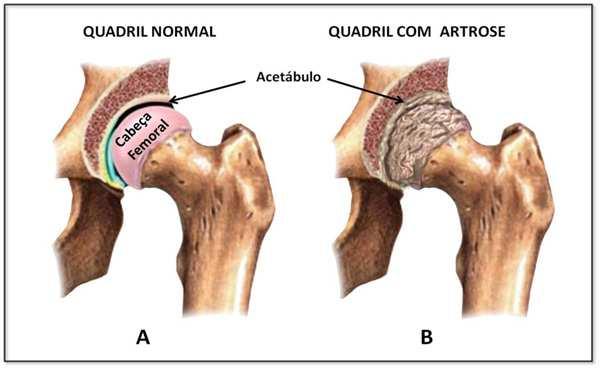 Parcial: com a substituição apenas de uma superfície articular (ex: na artroplastiaparcial do quadril, a cabeça e o colo do fêmur são substituídos por uma prótese, mas o acetábulo não.
