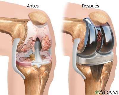 Artroplastia Complicações cirúrgicas: atrofia, infecções,