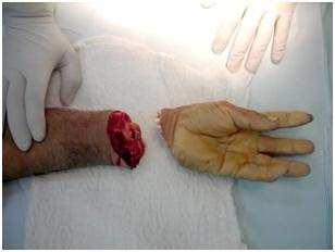 Cirurgias Vasculares Amputação de Membros Isquemiados Os cuidados com o coto são: Não colocar esparadrapo diretamente