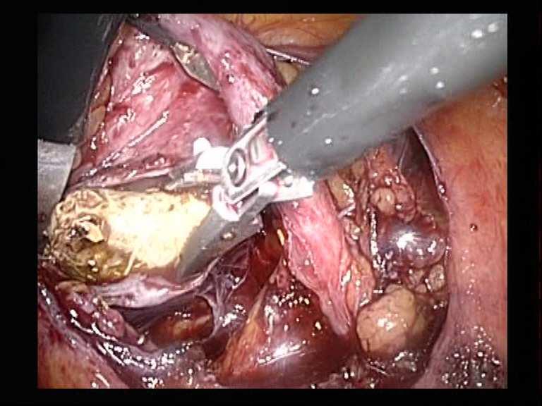 Cirurgias Urológicas Pielolitotomia Pré operatório: Observar volume e aspecto da diurese Verificar sinais