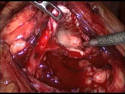 Cirurgias Urológicas Pielolitotomia Pós operatório: Verificar sinais vitais; Observar sinais de choque; Fazer