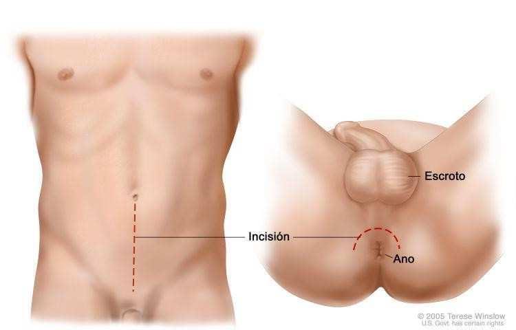 Cirurgias Urológicas Prostatectomia A cirurgia pode ser por