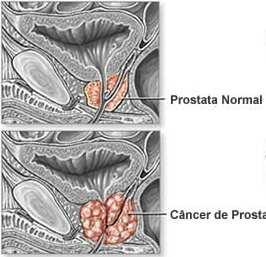 trans-uretral).