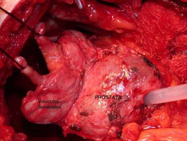 Cirurgias Urológicas Prostatectomia Pré operatório: Fazer controle de diurese; Oferecer líquidos; Jejum de 8 horas; Fazer enteróclise, spm; Tricotomia: nas técnicas por via uretral (RTU)