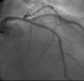 Foi submetido a coronariografia que demonstrou lesões obstrutivas importantes nas artérias descendente anterior (DA) e em seu grande ramo diagonal (DG).