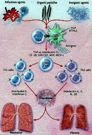 Discussão Doença granulomatosa, de etiologia desconhecida, cuja patogênese parecem participar os fatores genéticos, imunológicos, ambientais e infecciosos