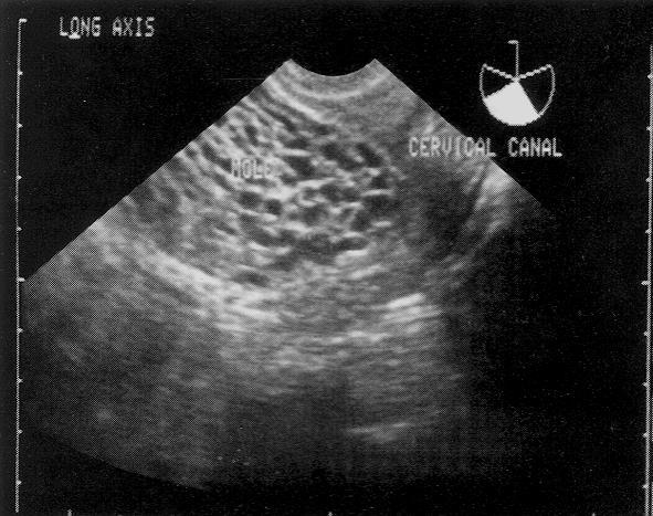 000 mui/ml ULTRASSONOGRAFIA: Forma completa: sem feto, massa heterogênea