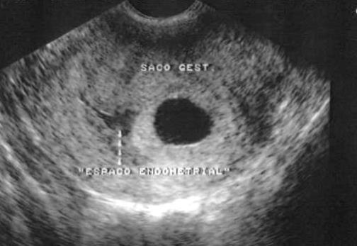 ULTRASSONOGRAFIA DE 1º TRIMESTRE 1ª ETAPA - AVALIAÇÃO GERAL SACO