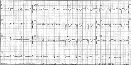 inferior wall. A year after hospitalization, the patient had had no new episodes of angina or signs of heart failure. Figura 1.
