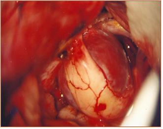 4 MÉTODOS 29 AN NO Figura 5 - Fotografia microcirúrgica de aneurisma gigante do segmento oftálmico da artéria carótida interna esquerda.