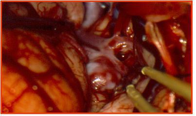 4 MÉTODOS 31 M1 Lobulação Pinça Bipolar Figura 7 - Fotografia microcirúrgica demonstrando aneurisma complexo da bifurcação da artéria cerebral média direita.