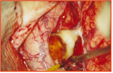 4 MÉTODOS 32 fundo, avermelhado e o corpo, mais claro, que à manipulação mostrou-se endurecido por cálcio. O colo é largo e também rígido. A figura 9 evidencia maior exposição do fundo do aneurisma.