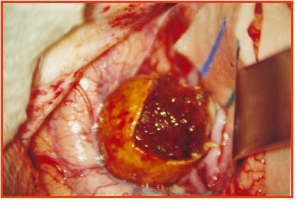 Início da trombectomia Figura 12 - Fotografia microcirúrgica de