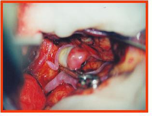 Naqueles casos, como o demonstrado na figura 15, em que havia trombose intra-aneurismática, impedindo a oclusão do colo do aneurisma com clipe, ou se verificava efeito de massa sobre o tecido