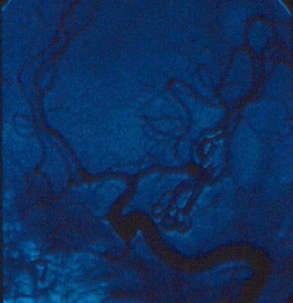 Figuras 17 e 18 - Angiografias cerebrais, por cateterismo femural (pré e pós operatório, demonstrando total oclusão do aneurisma) Durante a craniotomia e a microdissecção cirúrgica das cisternas