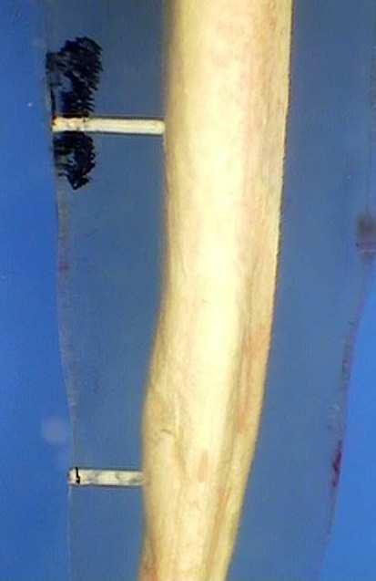 De outra forma, quando a imagem radiográfica era negativa e observava-se a presença do cimento obturador no canal lateral por diafanização, o preenchimento foi considerado presente (Figura 11).