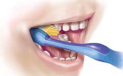 Dentífrico É essencial que tenha flúor na sua composição (1000-1500 ppm).