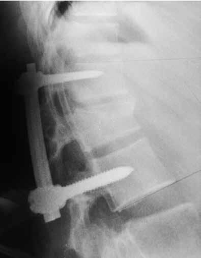 Ela pode estar associada a outras lesões, tais como fraturas em outros níveis da coluna vertebral, de membros, da bacia e lesões em tórax e abdômen (4).