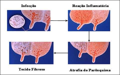 Mastite causada por Staphylococcusaureus.