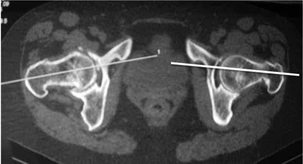 Anteversão femoral e ângulo cervicodiafisário: relação com a osteoartrite do quadril 71 Figura 1B Tomografia computadorizada da coxo femoral e côndilo femoral bilateral com as medidas respectivas.