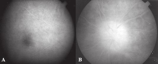 170 Portes ALF, Ramos CVF, Nunes JS, Valdetaro R, Monteiro MLR Figura 2: Angiofluoresceinografia normal no olho direito (A) e evidenciando extravasamento de contraste do disco óptico no olho esquerdo