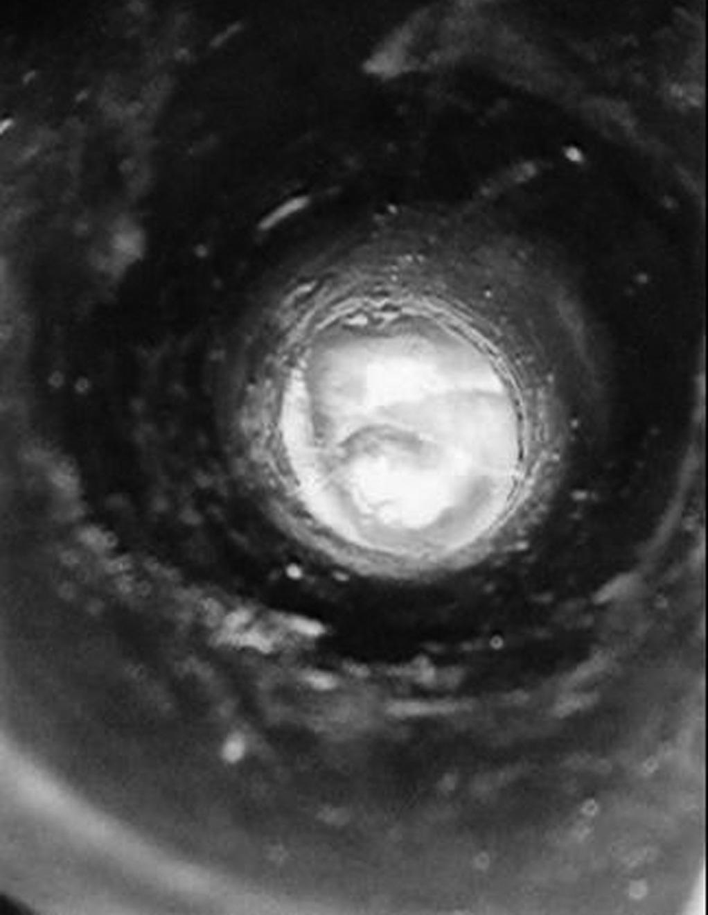 A borda da perfuração foi removida com um estilete em ponta reta e, posteriormente, um estilete curvo foi utilizado para escarificar a face mucosa da membrana timpânica.