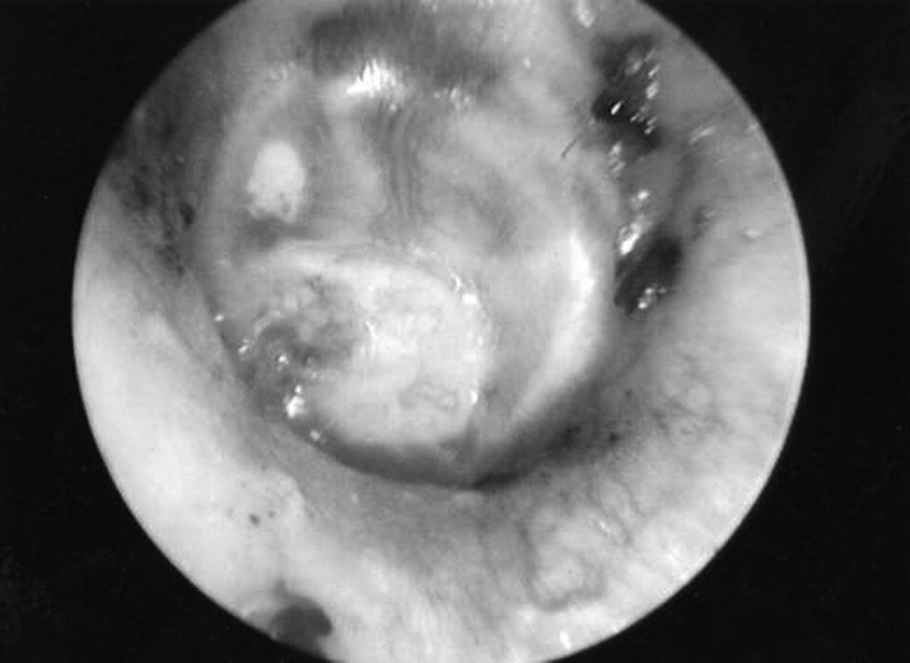 Figura 4. Aspecto da otoscopia com uma semana de pós operatório (Figura 2). A seguir, o enxerto foi encaixado na perfuração com fixação perfeita (Figura 3).