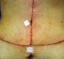 C Figura 7 Paciente do sexo feminino, 38 anos de idade, submetida a abdominoplastia em