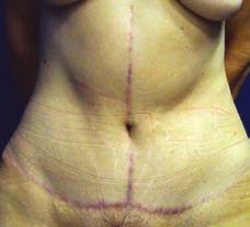 Reno et al. Figura 10 Paciente do sexo feminino, 43 anos de idade, submetida a abdominoplastia em âncora e neoumbilicoplastia pela técnica proposta após grande perda ponderal.
