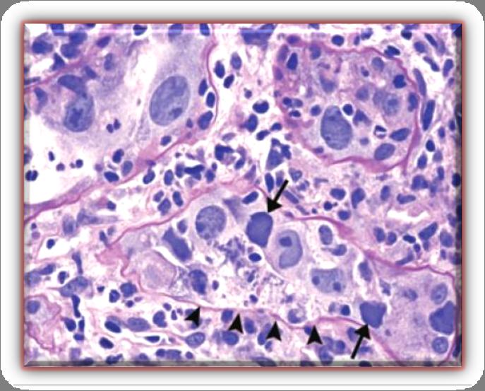 Fig. 5 NBKV. Observam-se células tubulares epiteliais com corpos de inclusão viral ( ), lise celular e desnudação da membrana basal tubular ( ).