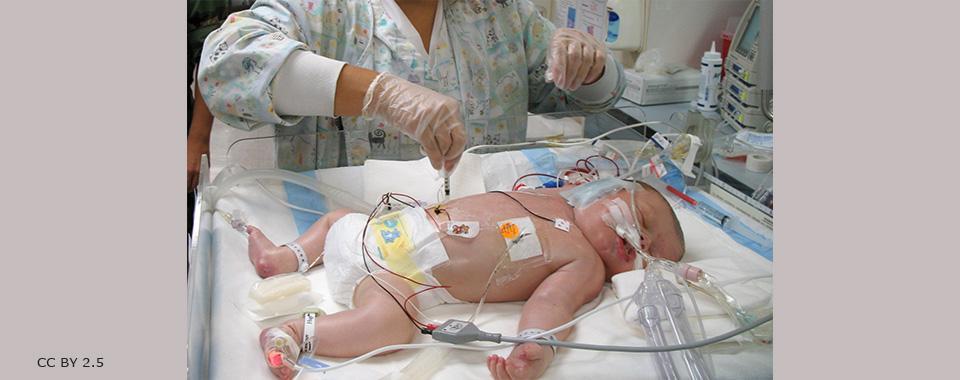 Aspiração de Mecônio Geralmente um bebê com síndrome de pós-maturidade expeliu o mecônio no útero.