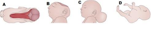 15 2. REVISÃO DE LITERATURA 2.1. DEFEITOS DO TUBO NEURAL Os defeitos do fechamento do tubo neural (DFTN) consistem em imperfeições no desenvolvimento fetal, divididos em craniosquise e espinha bífida.