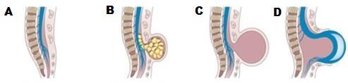 16 Figura 2 a: espinha bífida oculta; b: espinha bífida cística; c: meningocele; d: mielomeningocele Fonte: The grud code.