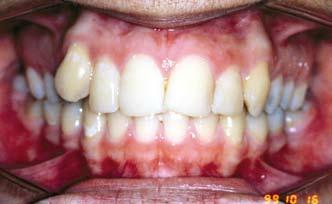 Orthodontic treatment has little to do with temporomandibular disorders. Evid Based Dent. 2004;5(3):75. 3. Slade GD, Diatchenko L, Ohrbach R, Maixner W.