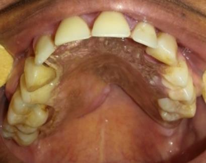 Figura 4: Radiografia oclusal total da maxila. Ausência de lesão óssea.