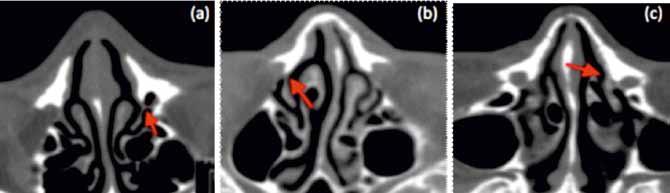 FL (linha vermelha). ultima imagem da FL (imediatamente anterior à imagem onde já se observava CNL). Esta medida resultou do somatório do número de cortes e do seu intervalo. 6.