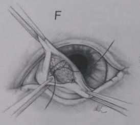 24 da conjuntiva remanescente sobre a glândula é separada parcialmente e realiza três suturas de Lembert subconjuntivais usando fio de sutura absorvível, sendo que, a glândula é pressionada de modo a