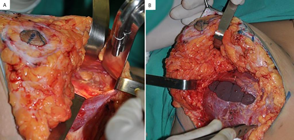 Simetrização com implantes submusculares Figura 7.