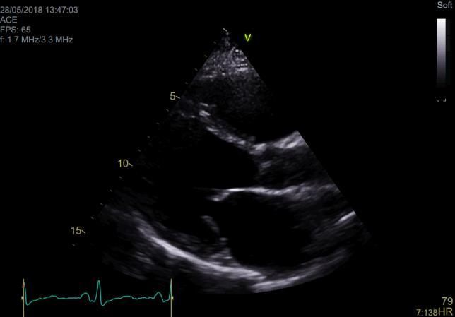 Caso Clínico 3 Exames complementares de diagnóstico: ETT: VE moderadamente dilatado com FEVE estimada em 25%, com