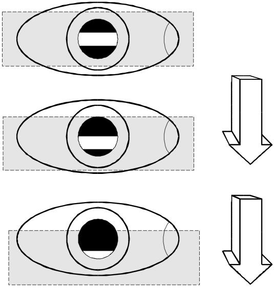 J) Utilizando o espelho plano comece por neutralizar o meridiano que possui a franja com menor movimento e mais brilhante (realizar o contrário com espelho côncavo).