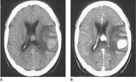 Figura 6: Imagem tomográfica em corte axial A) sem contraste e B) com contraste, evidenciando duas lesões tumorais (em branco). Fonte: Adaptado de MELO et al, 2003. 3.