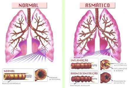 Doenças Respiratórias Neste tópico abordaremos questões sobre doenças respiratórias. Para aprofundamento do tema, recomendo a leitura do Tratado de Enfermagem Médico-Cirúrgica (Brunner e Suddarth).