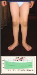 74 CRISTINA ALVES Figura 2. O ângulo de progressão do pé é estimado pela observação da criança a caminhar. A variabilidade da normalidade é mostrada a verde. Figura 3.