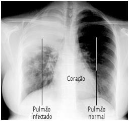 Pneumonia Causador: Streptococcus pneumoniae; Sintomas: febre alta, dores no peito e nas costas para respirar e tosse com