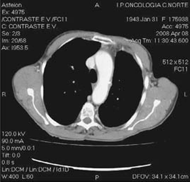 Fig. 3 TAC torácica (29/5/2007): Resposta parcial após início de tratamento com erlotinib Fig.