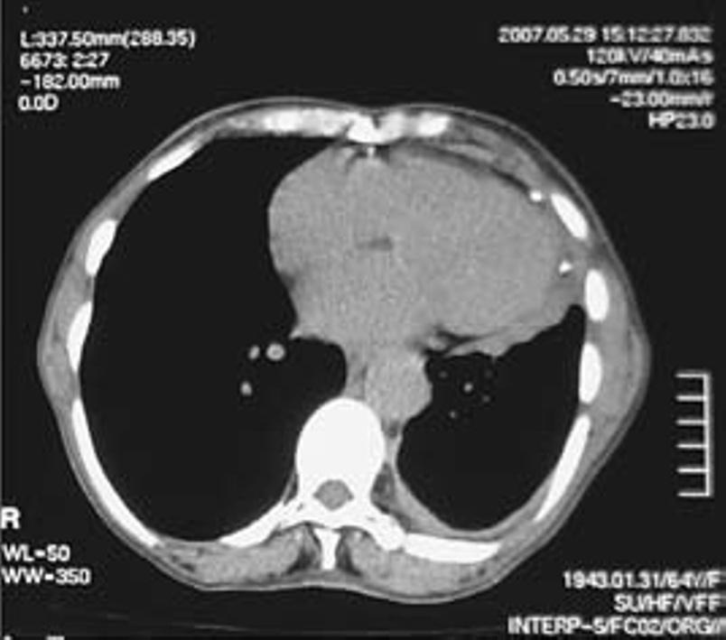 tosse e sem toracalgia. Mantém rash de predomínio cefalo torácico, grau 1-2 (NCI -CTC v3.