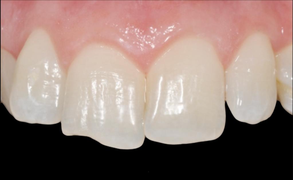 24 Figura 1 - Fratura incisal no