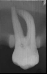As radiografias foram analisadas com auxilio de lupa de aumento 4X e negatoscópio por três diferentes observadores cirurgiões-dentistas igualmente calibrados